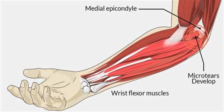 Why does my medial epicondyle hurt after working out?