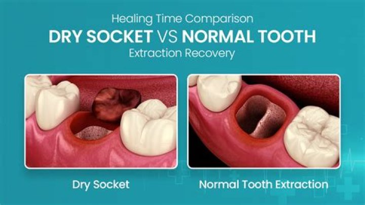 Why is proper suture placement so important when closing up an extraction site?